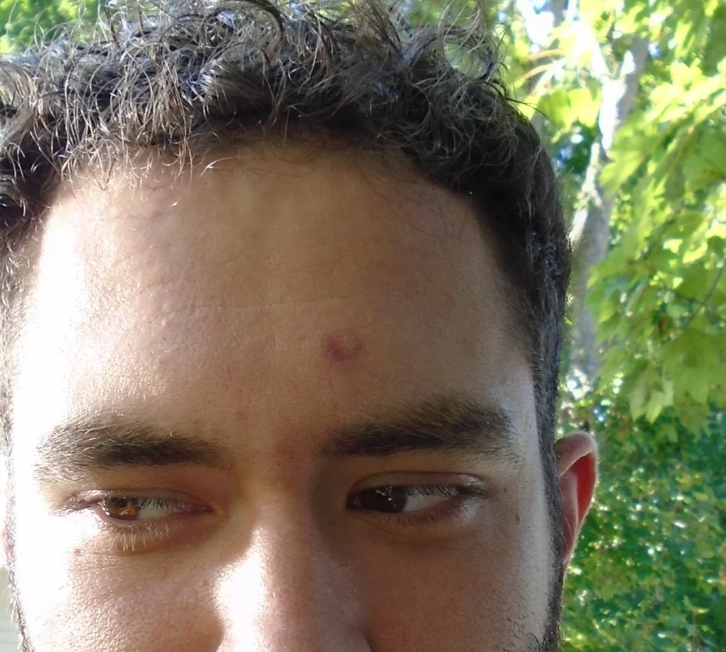 bb gun bruise (Copy)