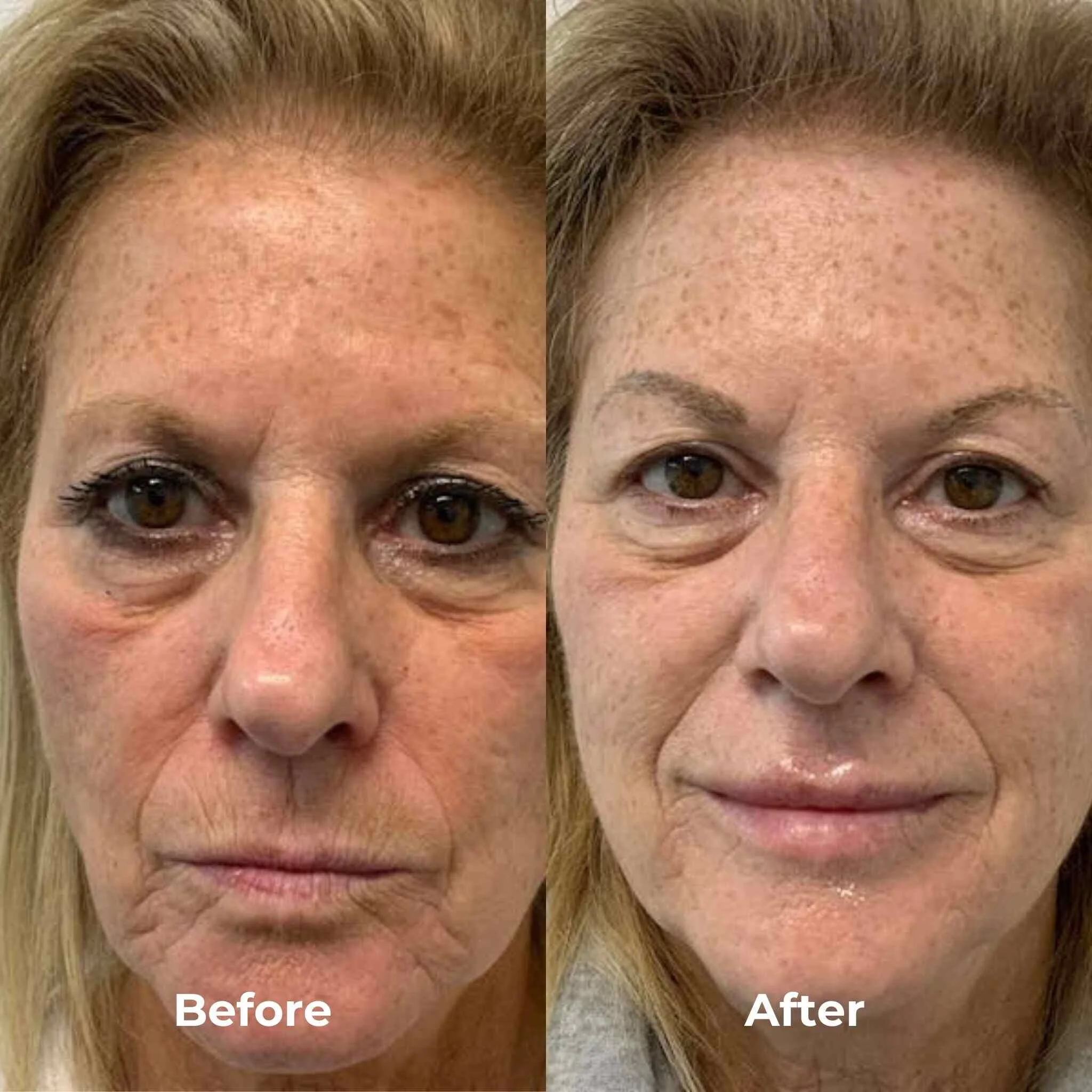 rf-microneedling-before-and-after-vivace-1-3740918632.jpeg