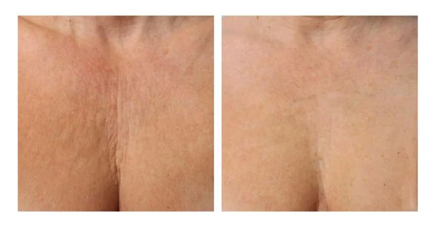 profhilo-decolletage-injections-before-and-after-848x447-3984318192.jpeg