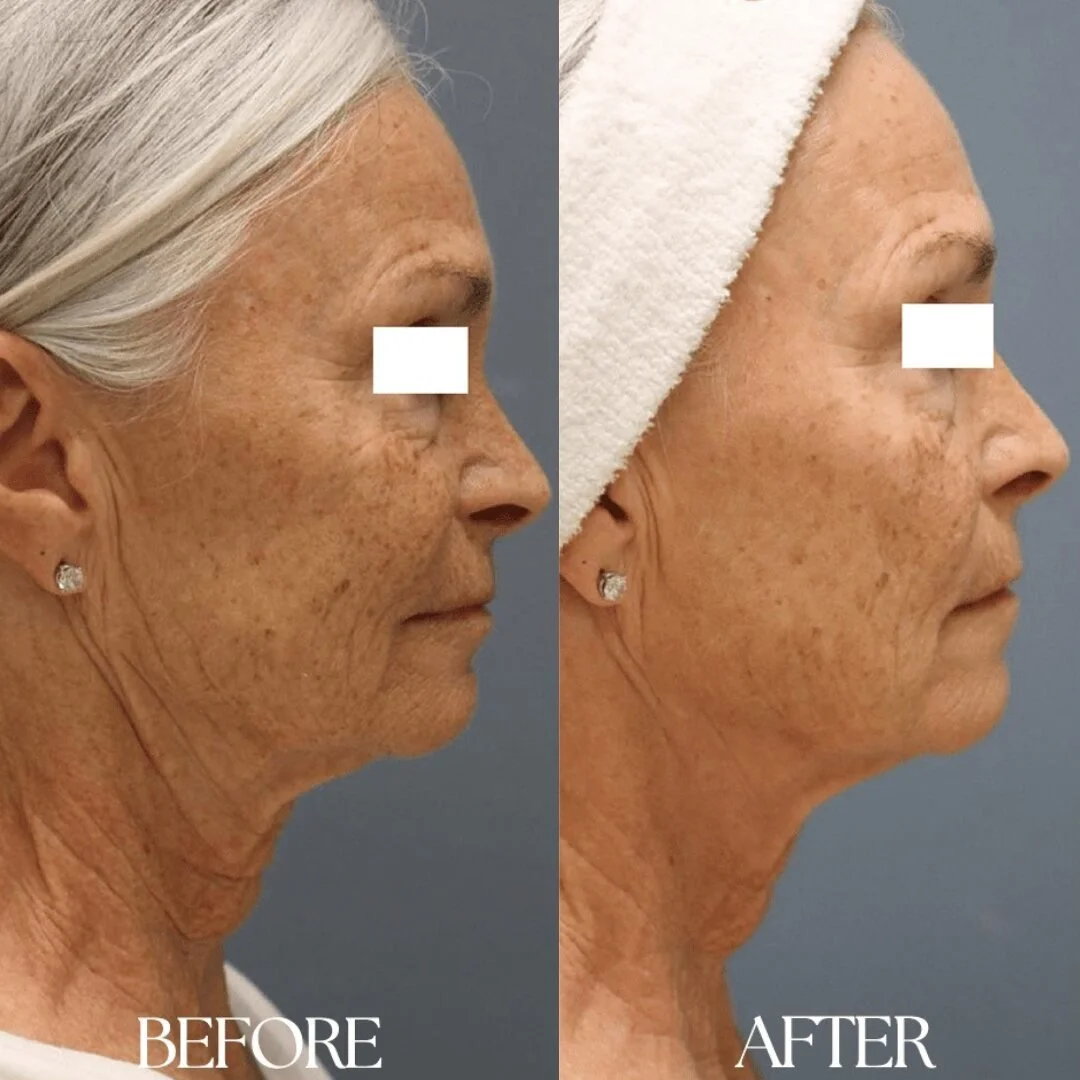 rf-microneedling-before-and-after-pixel8-rf-4-2321802118.jpeg