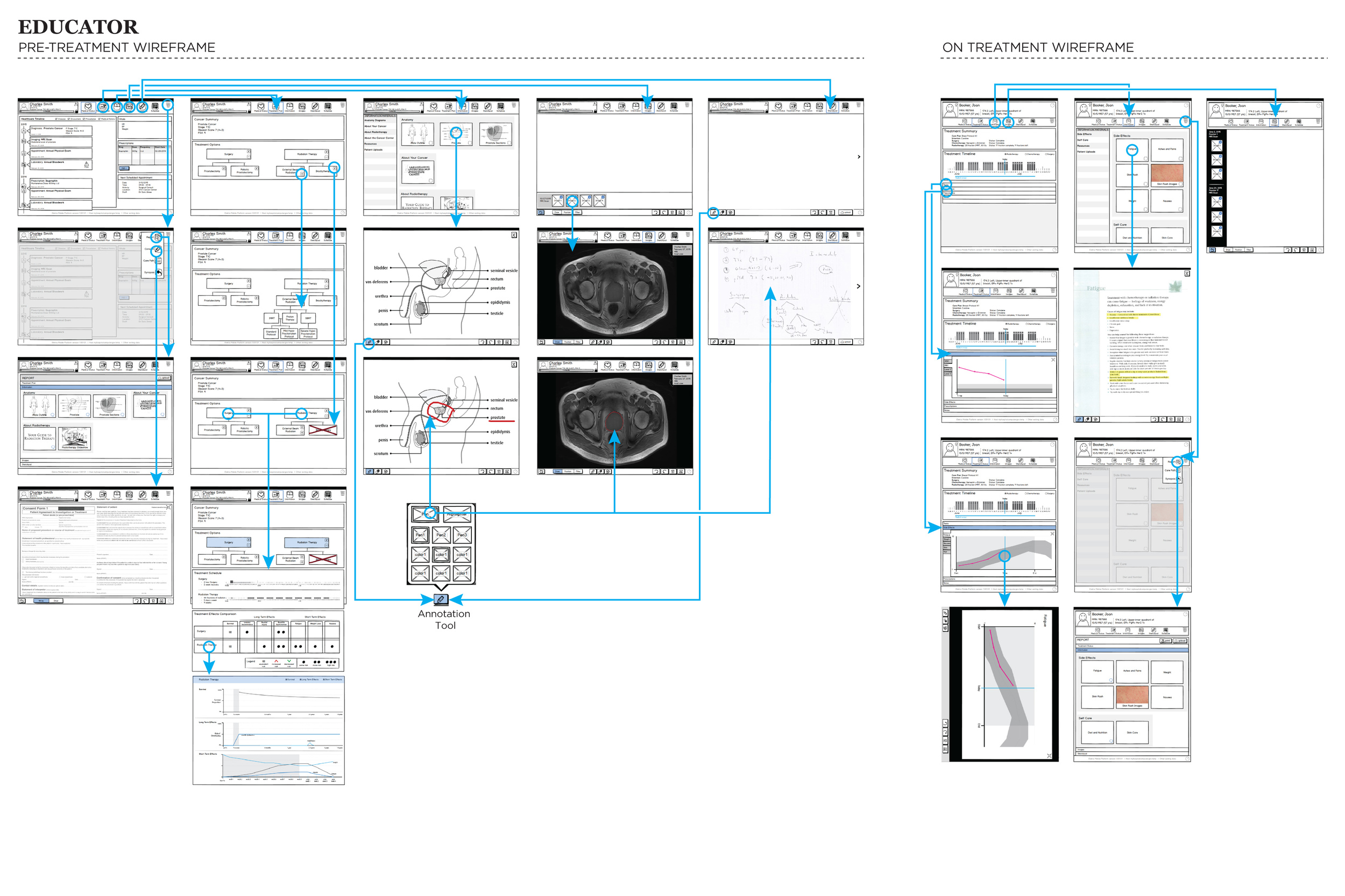  This image shows wireframes of the Educator software's two different configurations, which allow for tailoring the information presented to the patient based upon where they are in the treatment process, i.e.&nbsp;pre-treatment or on treatment.  I u