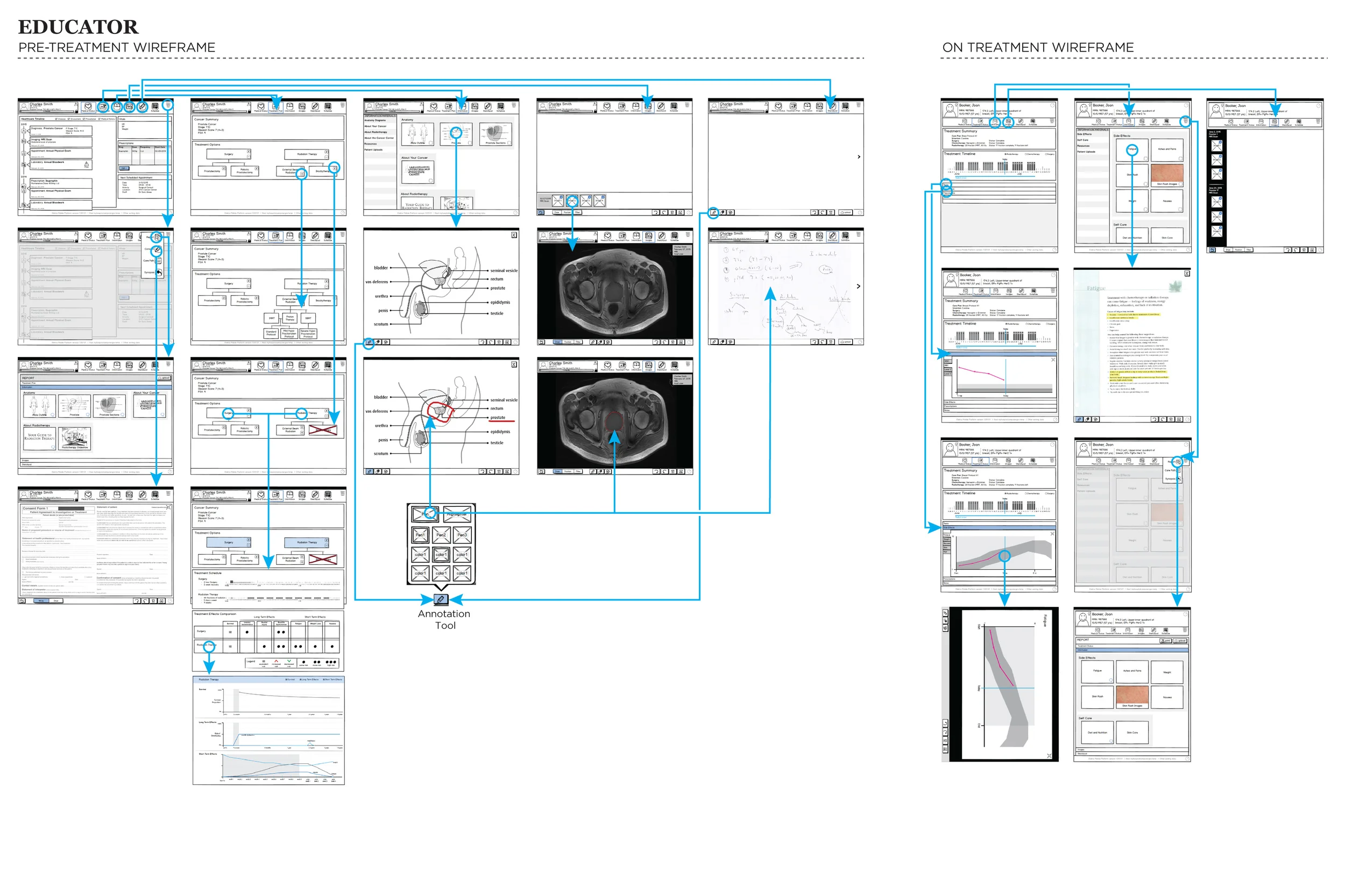 This image shows wireframes of the Educator software's two different configurations, which allow for tailoring the information presented to the patient based upon where they are in the treatment process, i.e. pre-treatment or on treatment. I used InVision to create a clickable prototype of these wireframes for user testing with Radiation Oncologists, Patient Educators, and patients.