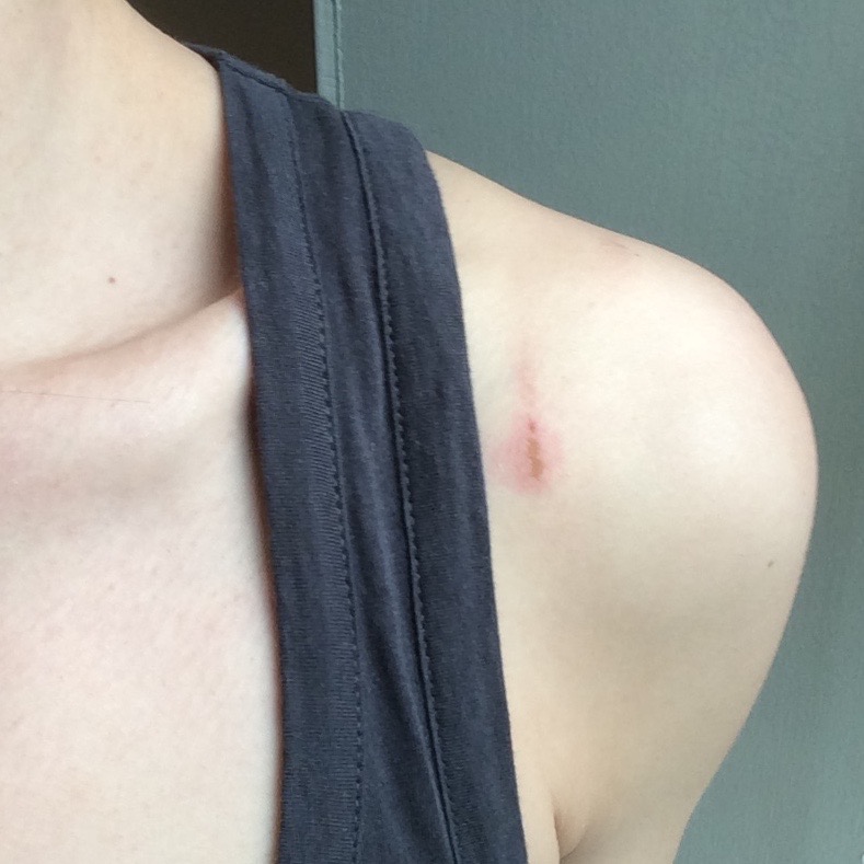 This is my shoulder, two days after a day-long trip with my cat. It was hot out, so I stripped down to my tank top for part of the day. The skin on both shoulders was rubbed raw, and the whole shoulder/back area is still tender from carrying her lop-sided all day. 