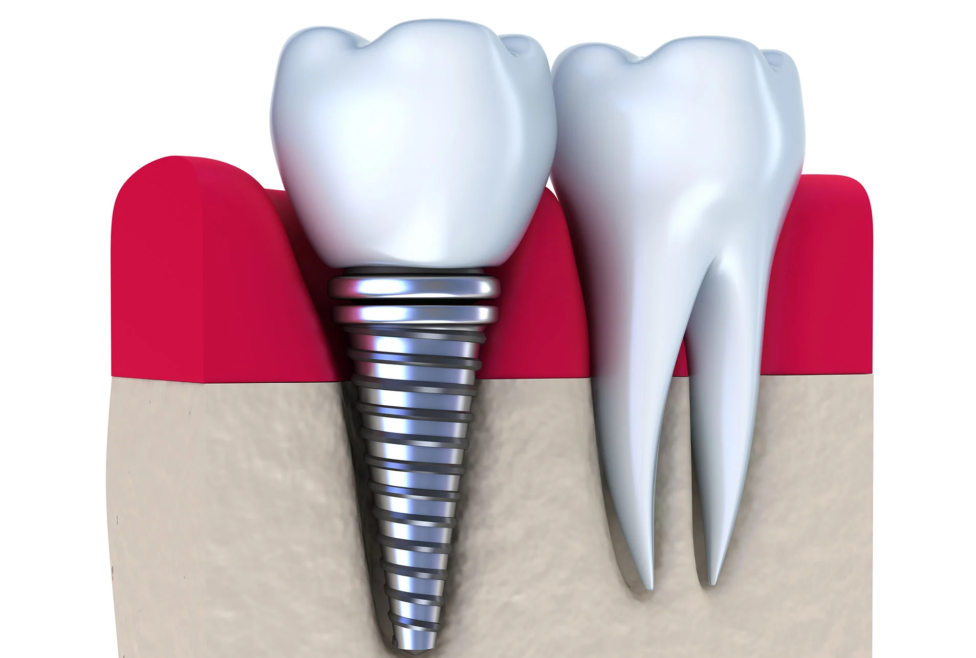 Dental-implants-cropped.jpg