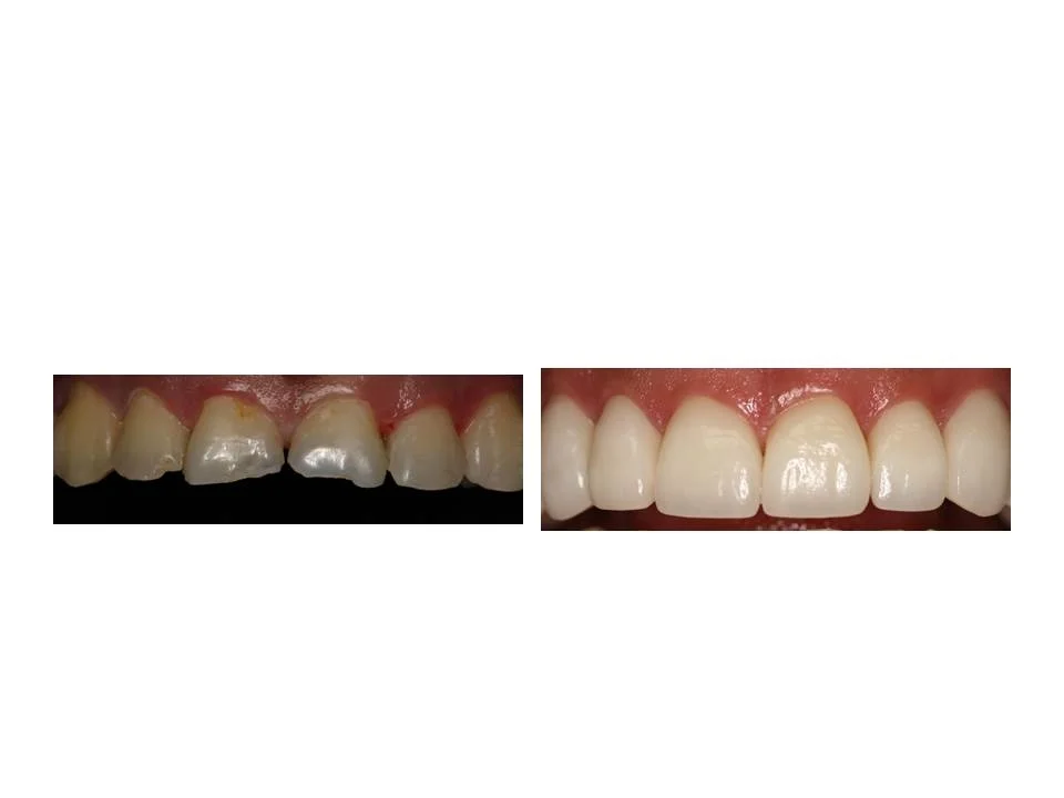Why Should You Consider Improving Your Smile: By Dr. Kaveh Ghaboussi