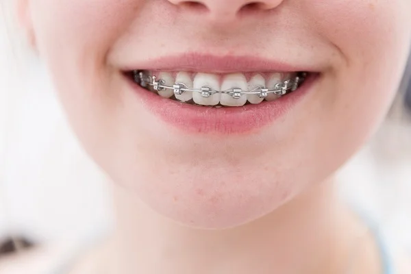 Why Taking Your Smile Into Your Own Hands With DIY Braces is a Bad Idea