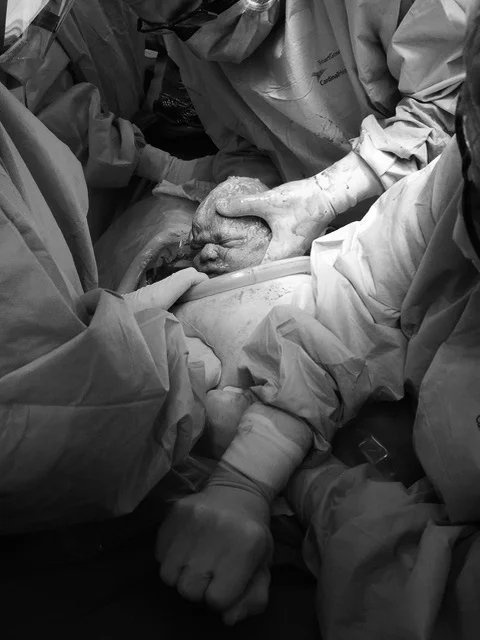 Cesarean Birth