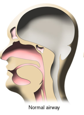 CPAP holds the airway open and allows air to travel through the nostrils, pass the tongue and down to the trachea