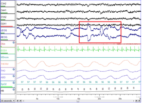  sleep study recording 