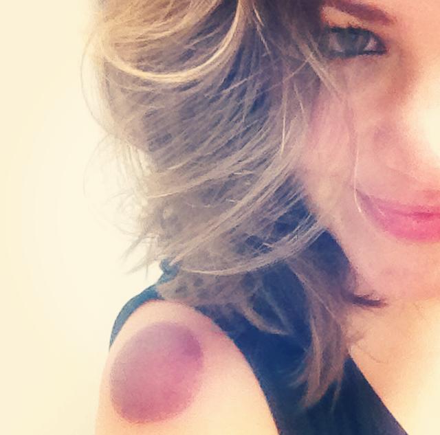 The results of cupping. Read Cupping, You Hurt So Good to see why I love it.