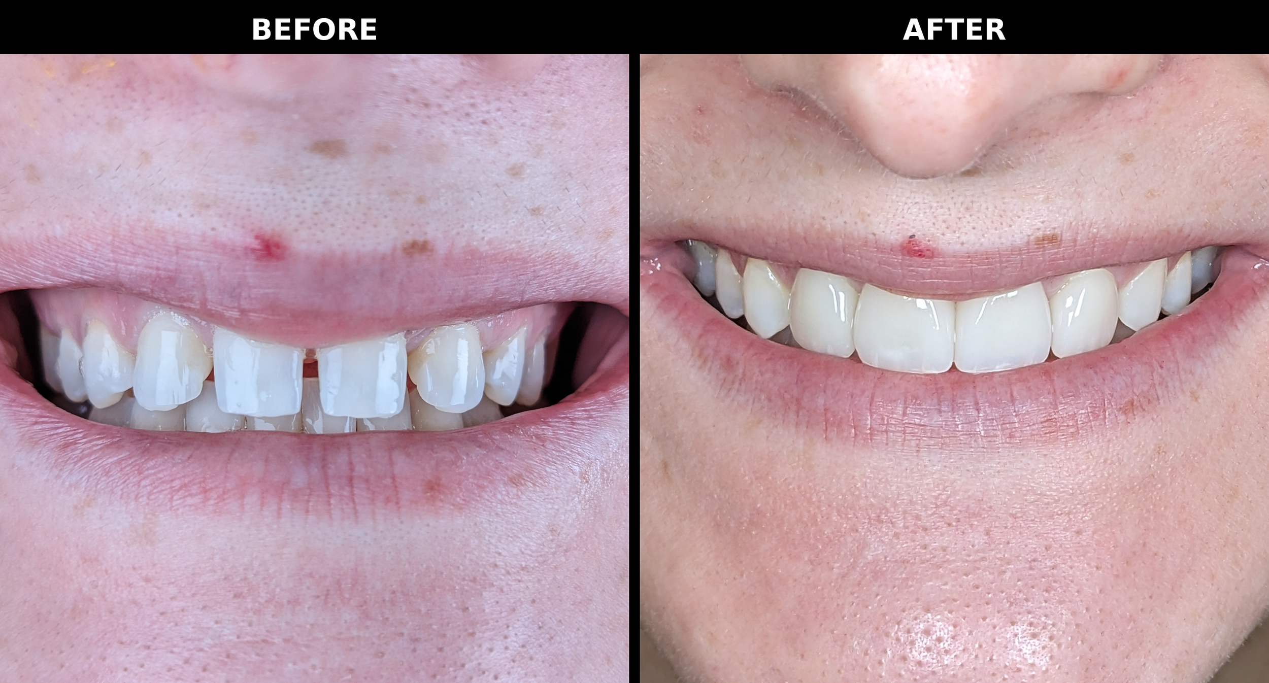 missing lateral incisors. Dental Implants not an option, so Dr. Michael Mostofi placed veneers on four front teeth for a uniform smile. — HealthySmile360, Laguna Niguel