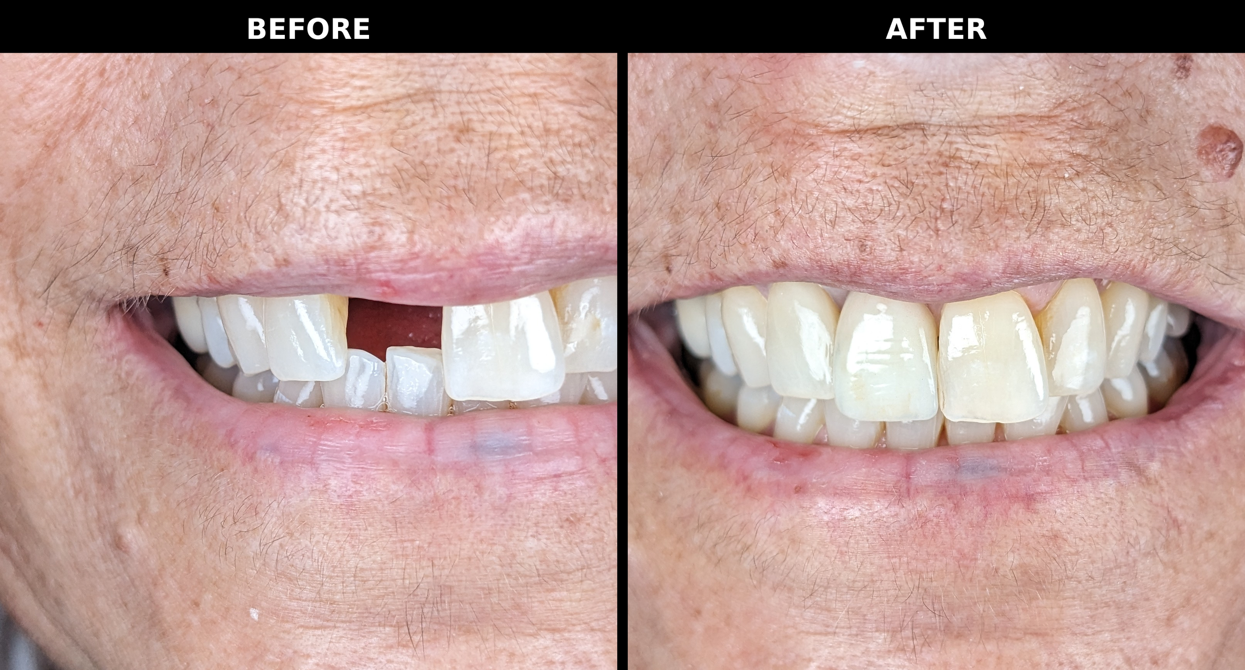 Single dental implant in the front — by Dr. Michael Mostofi at HealthySmile360, Laguna Niguel.