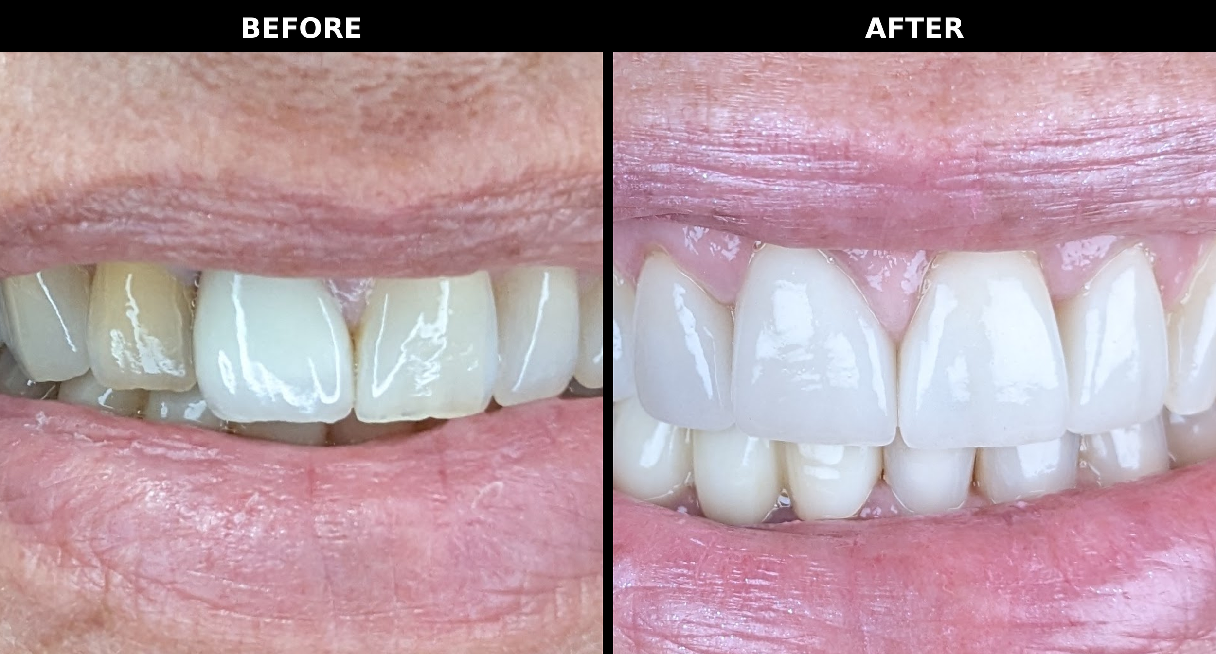  Four veneers across the front — by Dr. Michael Mostofi at HealthySmile360, Laguna Niguel. 