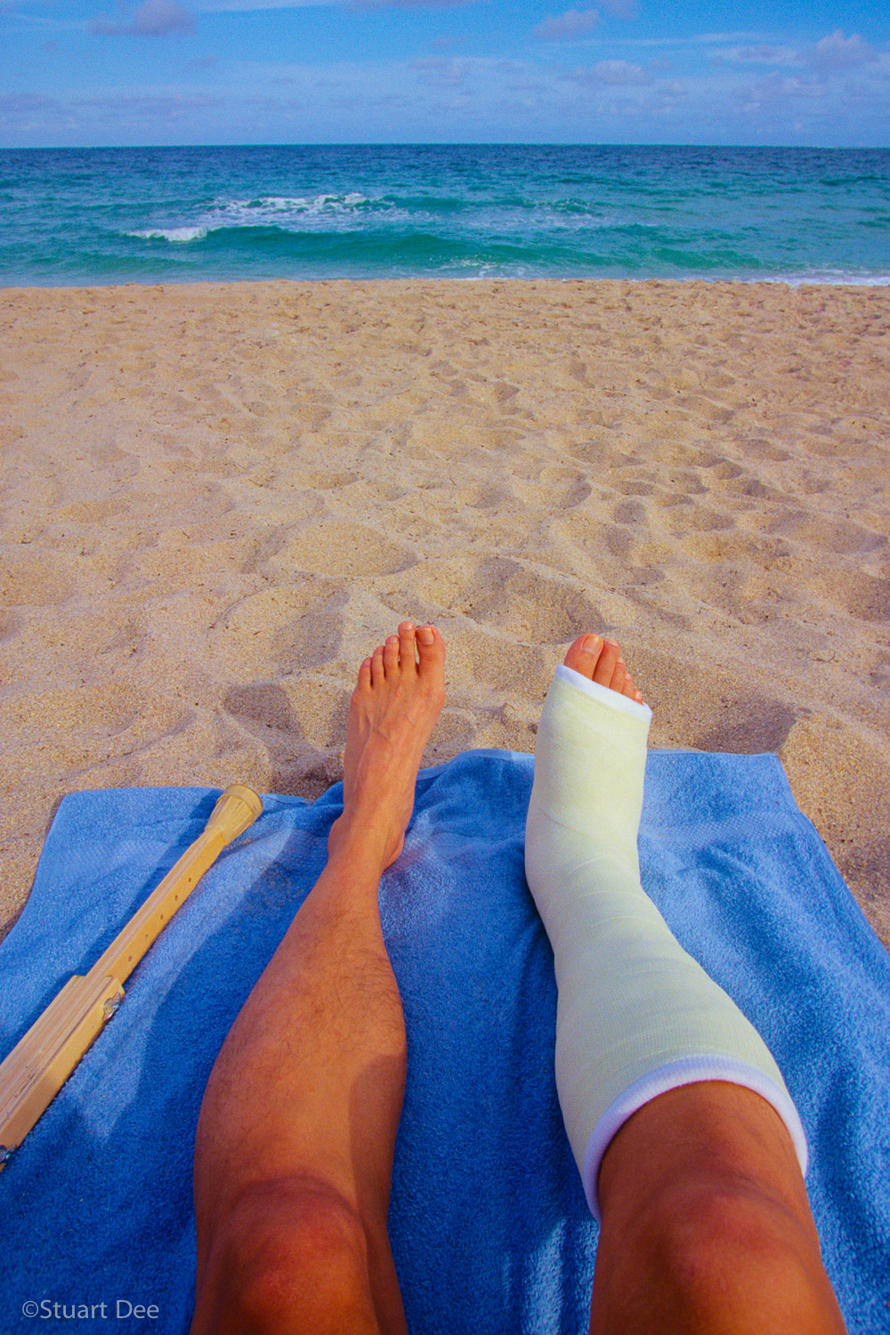  Man's legs and crutch on beach towel, Miami Beach, Florida, USA 
