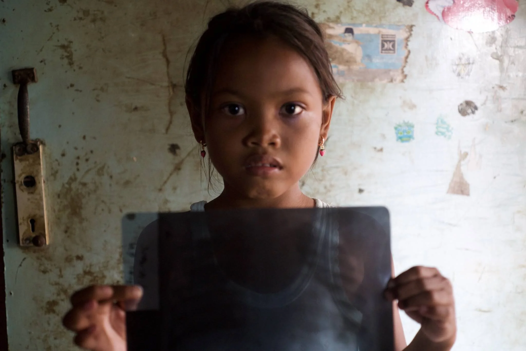 An 8-year-old girl from Indramayu shows an X-ray showing that she has lung disease (2017). Photo credits: Ardiles Rante
