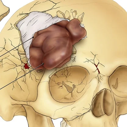 Traumatic Brain Injury