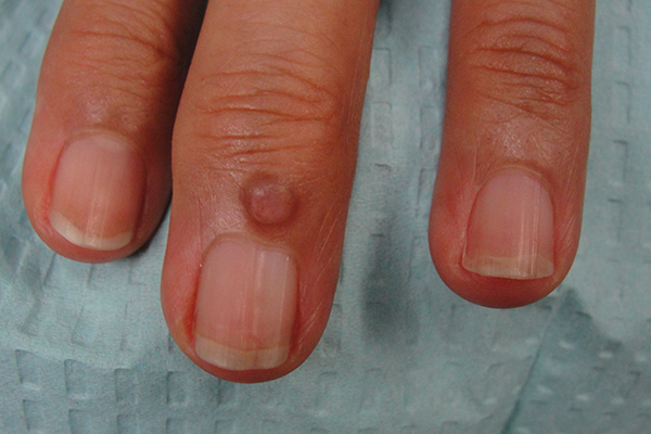 Myxoid Cyst — Dr Dana Stern Dermatologist Nail Specialist