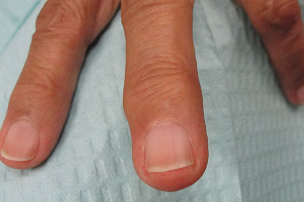 Post Treatment