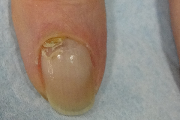 Pre Treatment