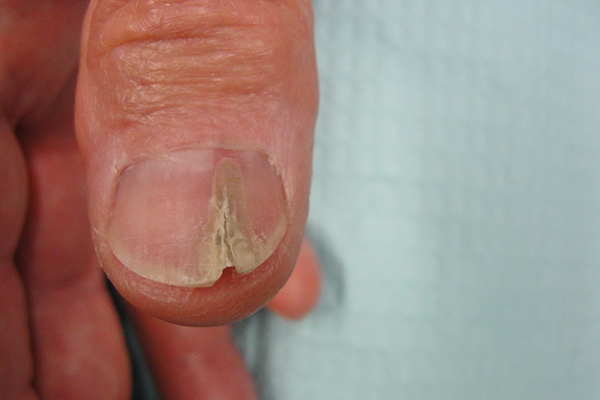 Pre Nail Biopsy