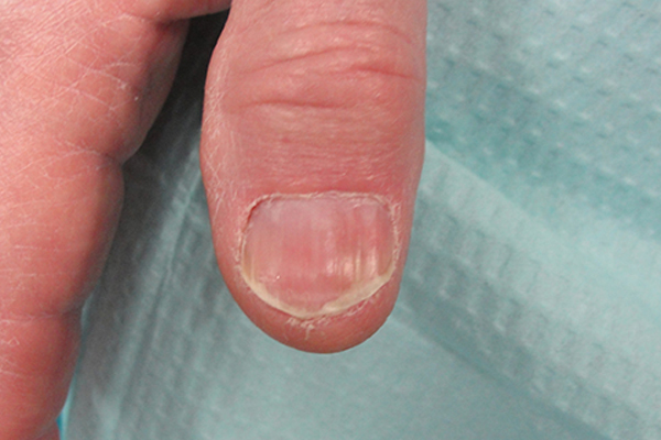 Post Nail Biopsy