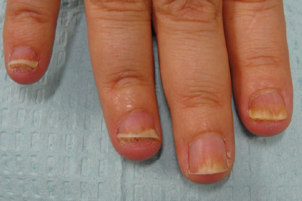 Difference Between Nail psoriasis and Nail fungus