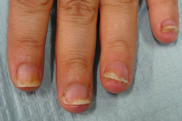 Pre Treatment