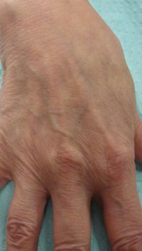 Pre-Treatment: 75 year old female pre-treatment; note the prominent veins and tendons and the wrinkled appearance of the skin