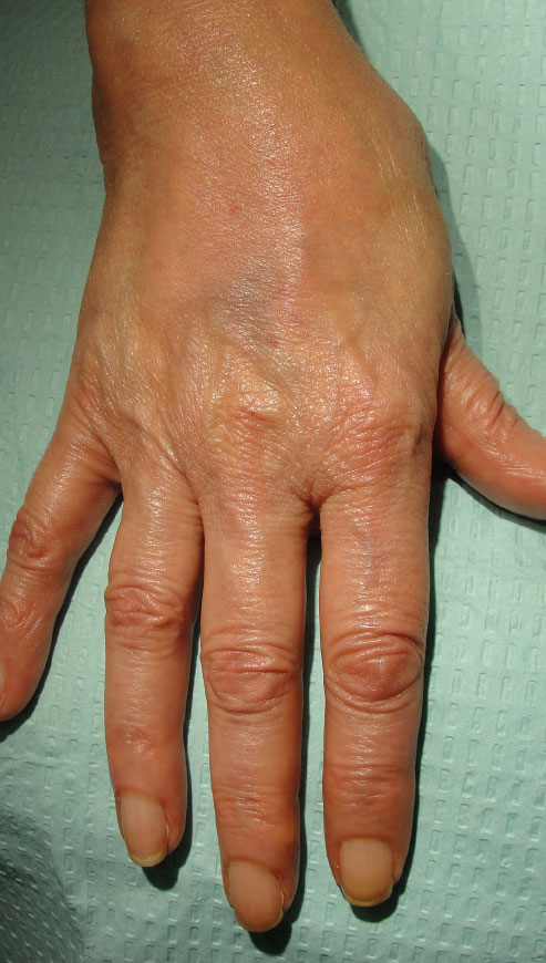 Post-Treatment: Immediately post treatment with Radiesse.™ The tendons and veins are less prominent. There is a small bruise from the injections that will resolve in a few days. The overall appearance of the hand is more supple and youthful and will continue to improve once the initial swelling resolves.