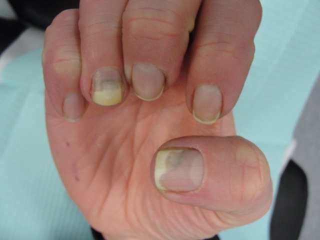 Pre Treatment