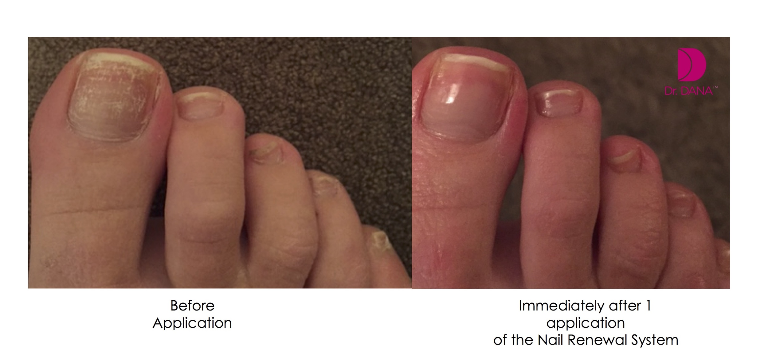 How long can you leave nail polish on your toes Nail News Dr Dana Stern Dermatologist Nail Specialist