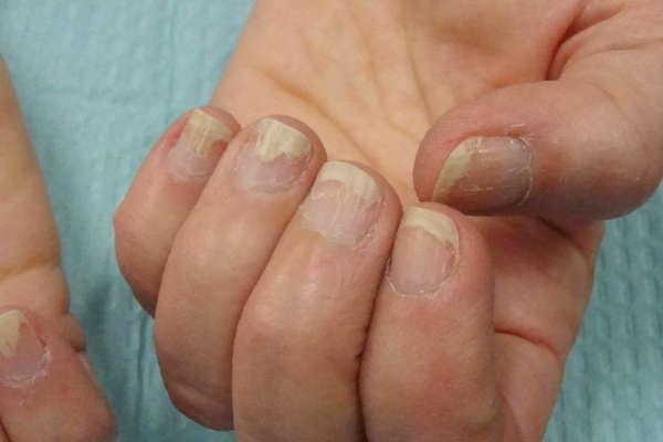 Pre Treatment
