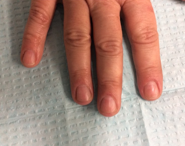 After Treatment