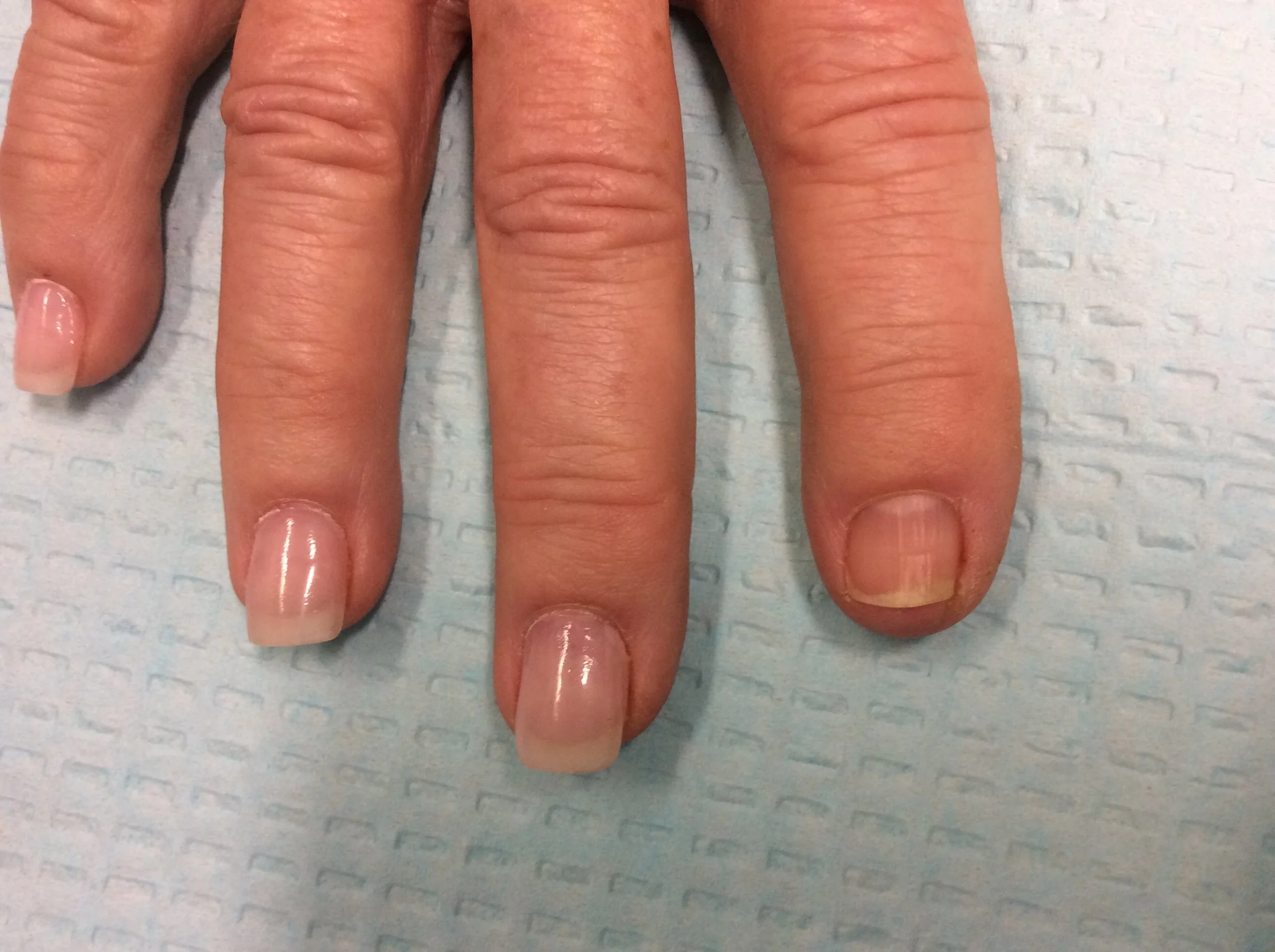 Post Treatment