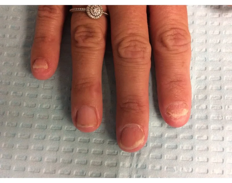 Before Treatment