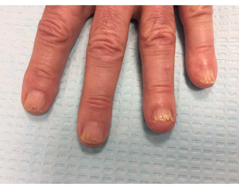 A) Lichen planus nail dystrophy with discoloration and fissuring of... |  Download Scientific Diagram