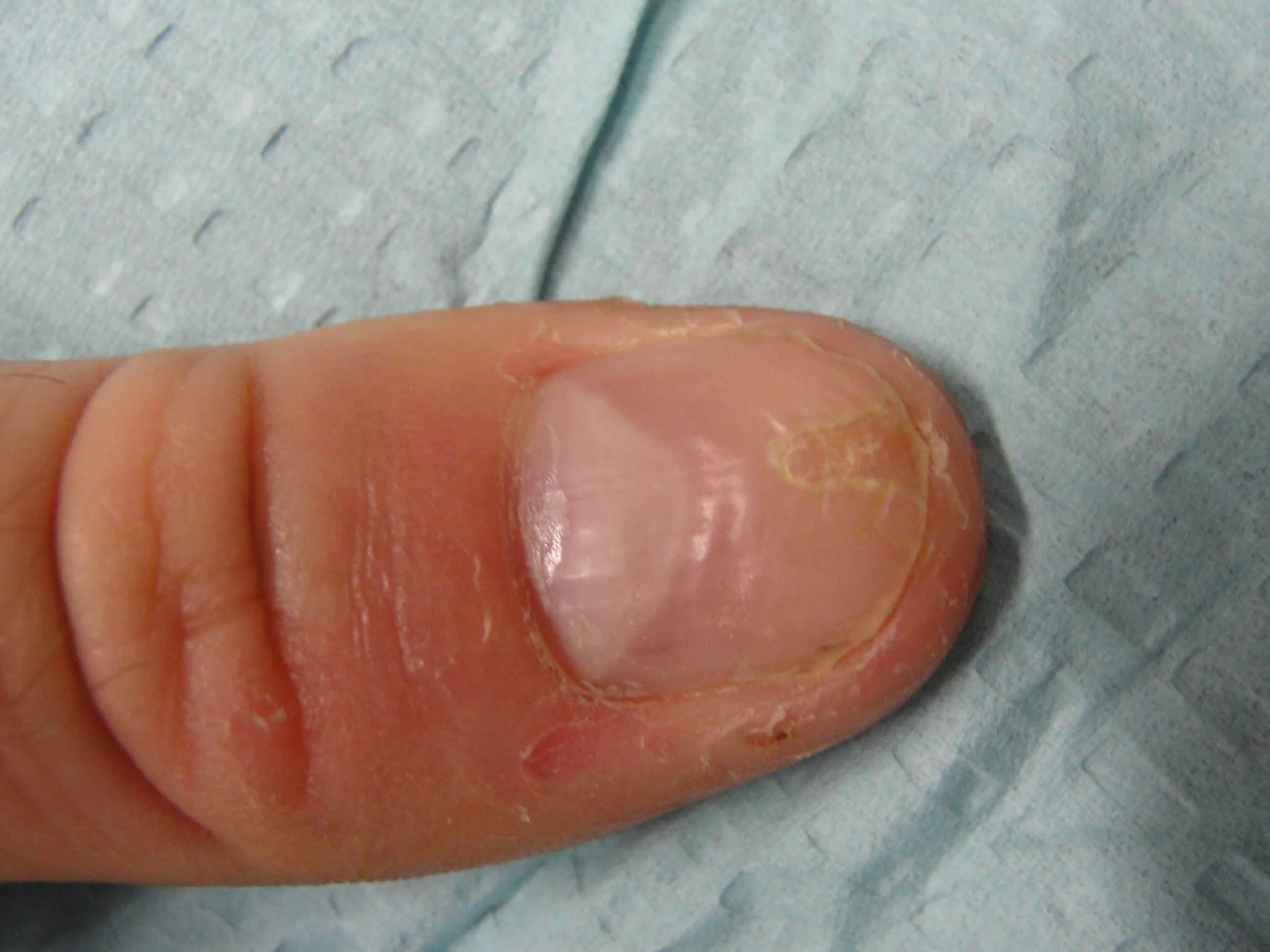 Habit Tic Deformity — Dr. Dana Stern Dermatologist Nail Specialist