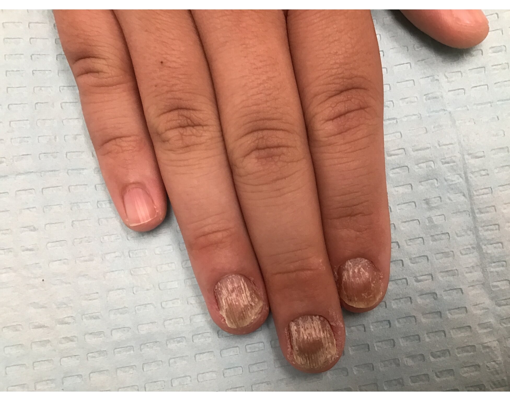 PDF) Plummer's nail (onycholysis) in an adolescent Nigerian girl with  hyperthyroidism due to Graves' disease