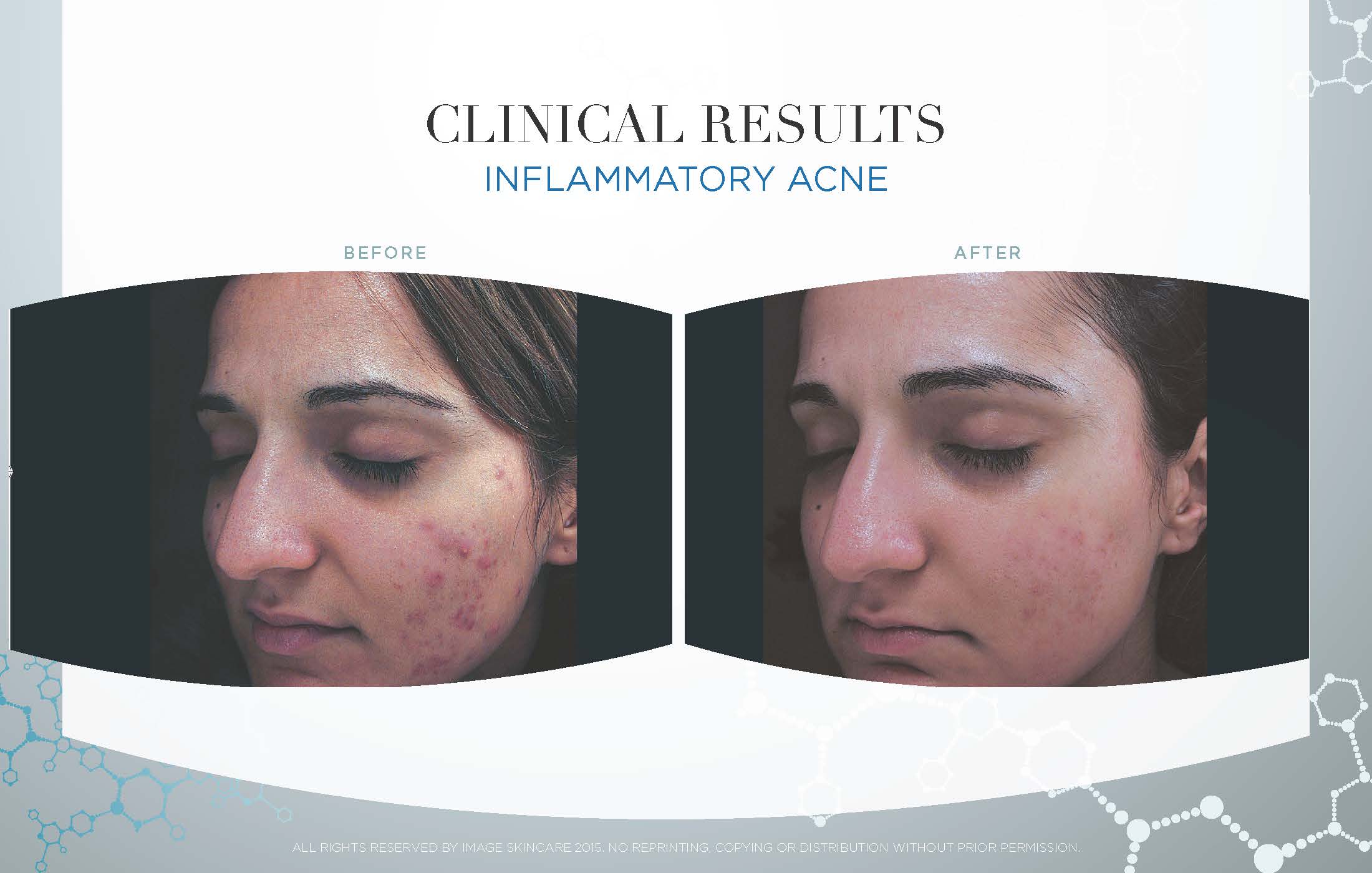 Series of 6 Image Designer Peels: 2 Signature Facelift and 4 Beta Lift Peels, and use of Image Skincare at-home regimen.