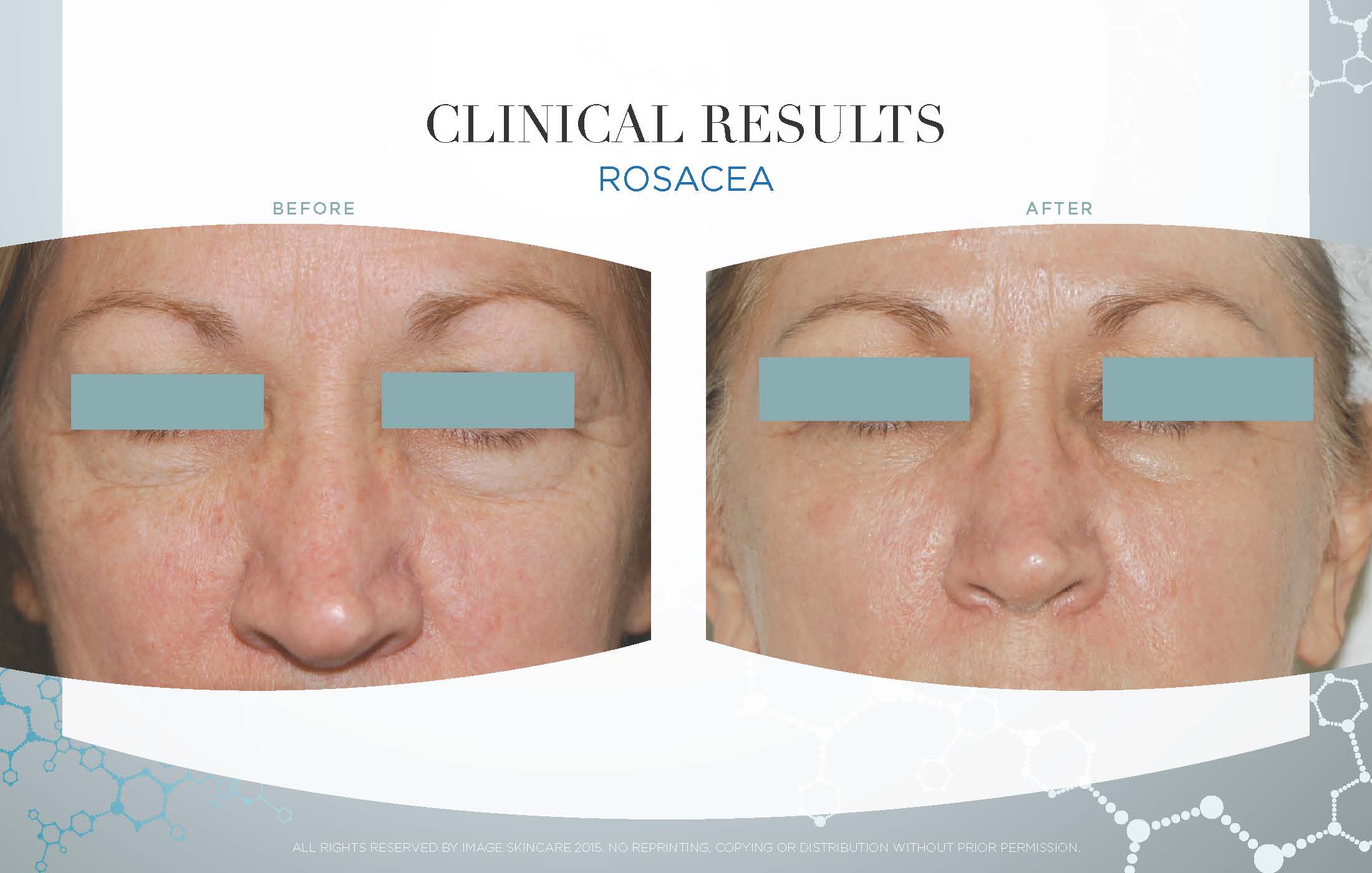Series of 6 Image Designer Peels: The Signature Facelift and use of Image Skincare at-home regimen. 
