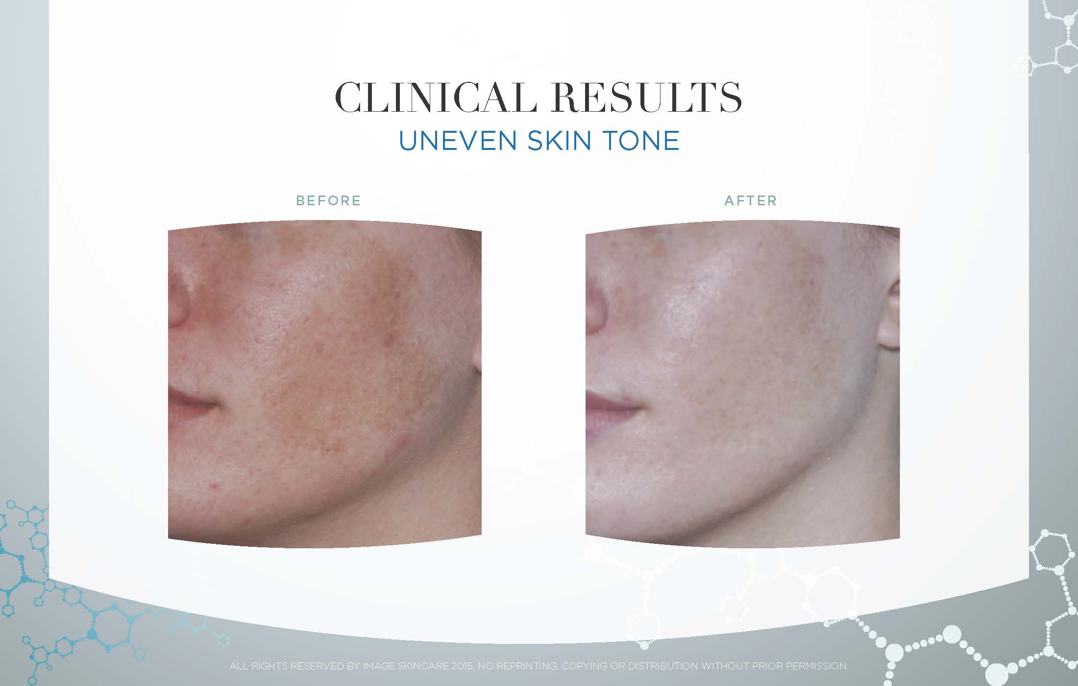 Series of 6 Image Designer Peels: Lightening Lift and use of Image Skincare at-home regimen.