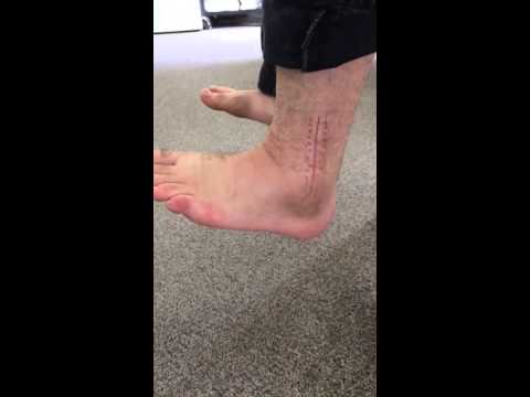 AROM Ankle Dorsiflexion