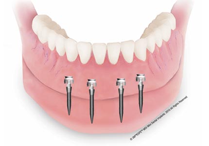 Snap-in Denture