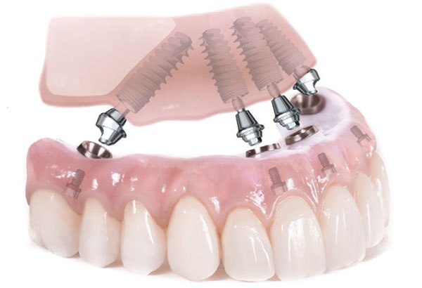All-on-four on denture teeth - notice the bulkier nature and excessive bulk of the restoration.