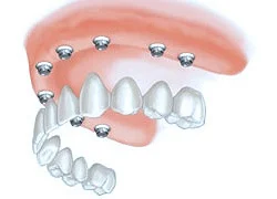 All-on-8 Implants