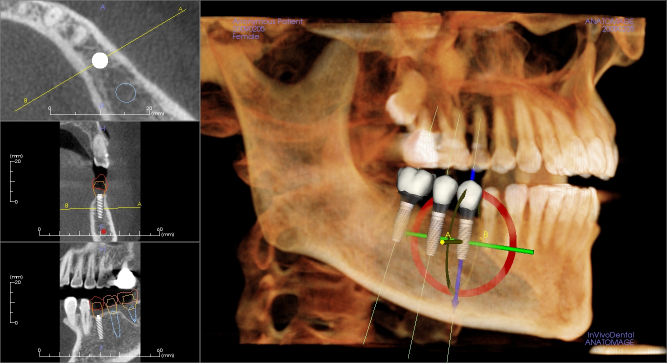 Lastest 3D imagingi technology enable accurate, safe, and predictable surgery.