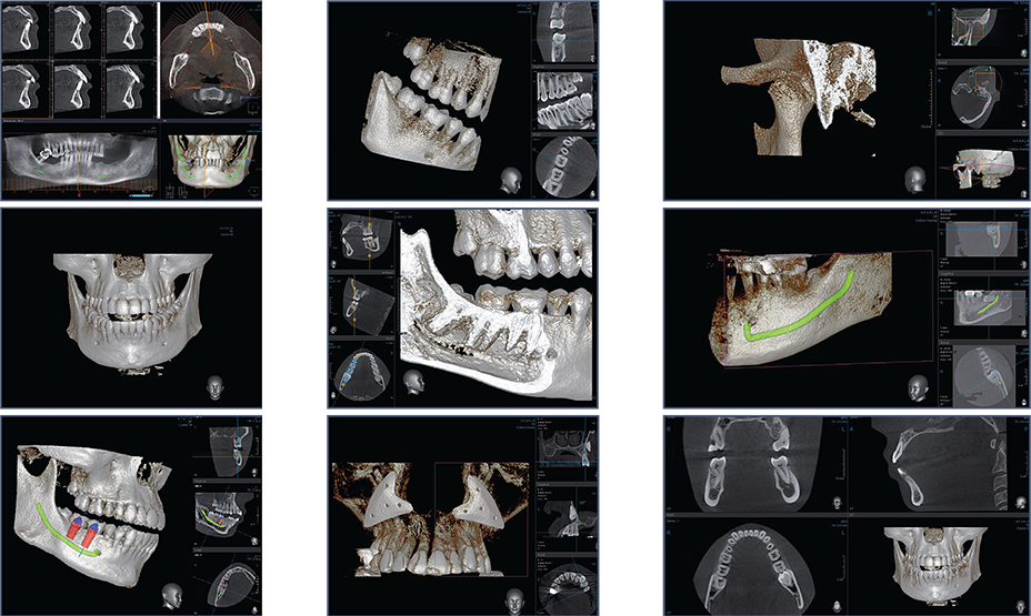 3D CBCT scan will be taken to determine patient's existing dental condition, volume of bone and anatomy.