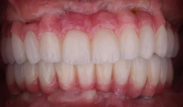 Teeth will be designed to best match patient's facial esthetics. Final zirconia bridge is delivered.