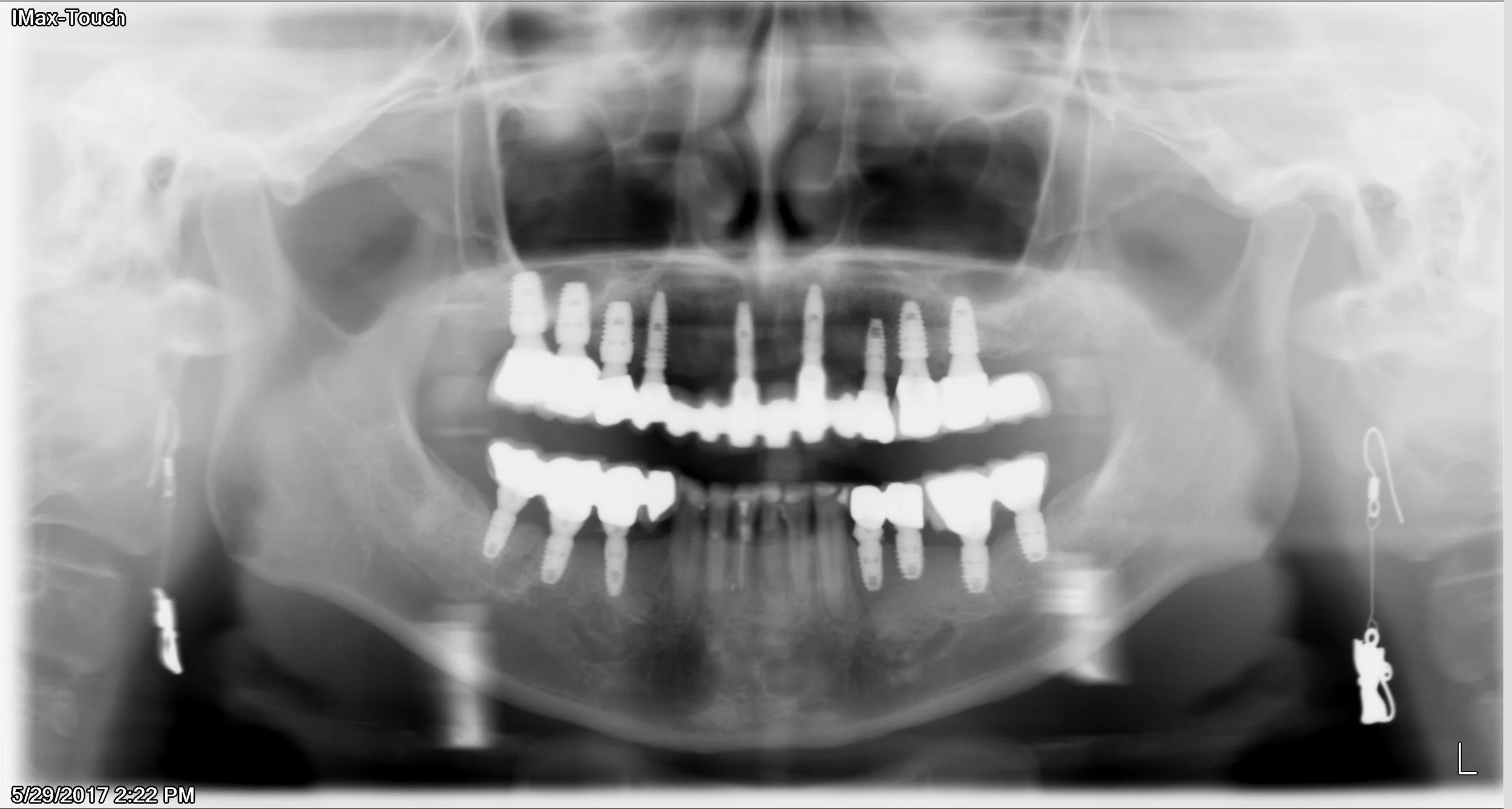 1DigX_05292017_142225 Copy.jpg