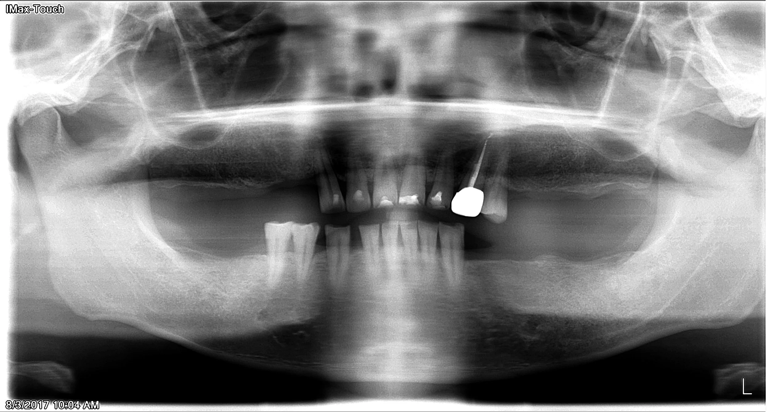 Before - Patient want to maintain his natural teeth , but cannot eat with partial dentures.